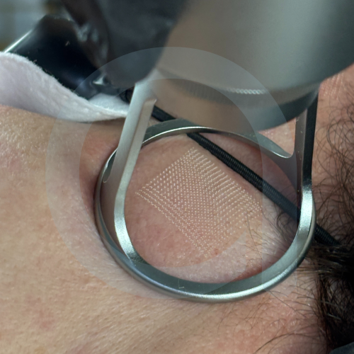 Aure Thullaris Pro laser tulowy.png